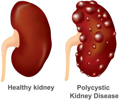 kidney